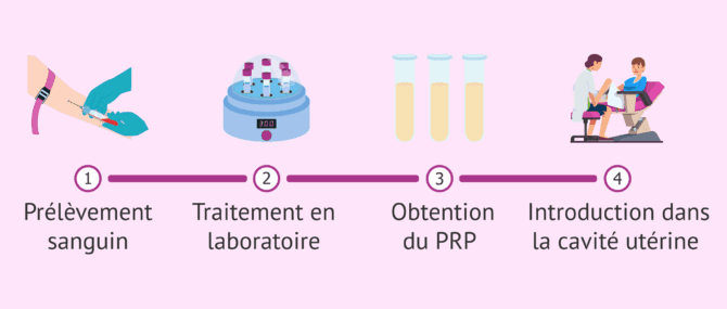 Imagen: Le plasma riche en plaquettes pour améliorer les chances de grossesse