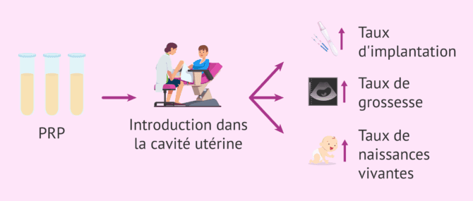 Imagen: Le plasma riche en plaquettes est-il efficace en procréation médicalement assistée?