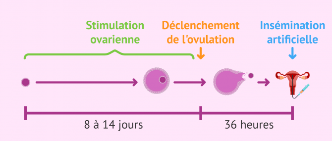 Imagen: La stimulation ovarienne lors d'une insémination artificielle