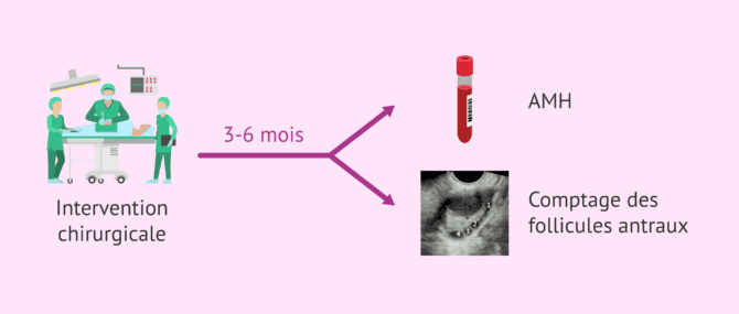 Imagen: Réserve ovarienne après une opération pour endométriose