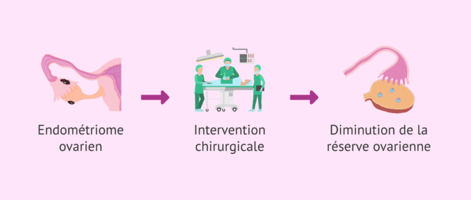 Imagen: Chirurgie de l'endométriose et dommages à la réserve ovarienne
