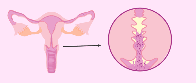 Imagen: Infertilité due aux anticorps anti-spermatozoïdes