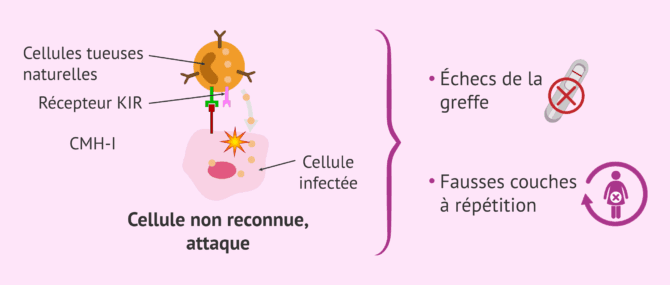 Imagen: Infertilité allo-immune due à des cellules NK élevées