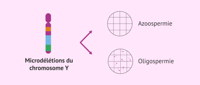 Imagen: Les microdélétions du chromosome Y comme cause d'infertilité masculine