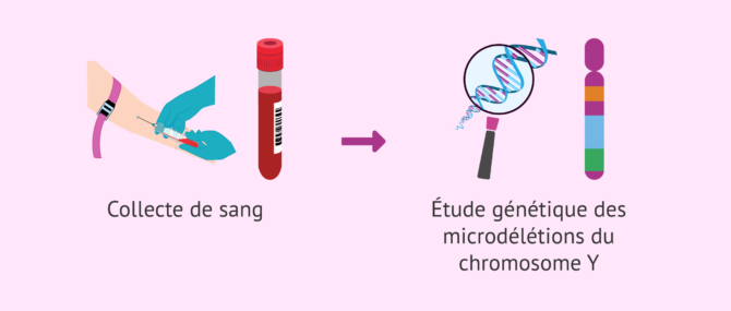 Imagen: Comment les microdélétions du chromosome Y sont-elles diagnostiquées?