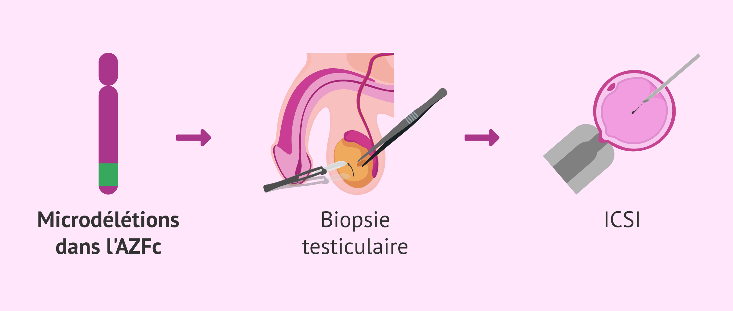 Techniques de procréation assistée avec microdélétions sur le chromosome Y
