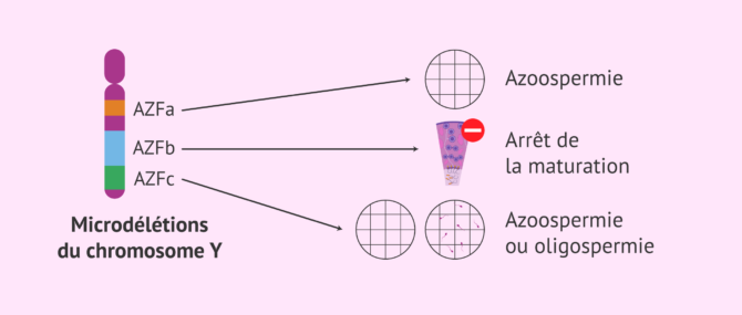 Imagen: Microdélétions du chromosome Y: types