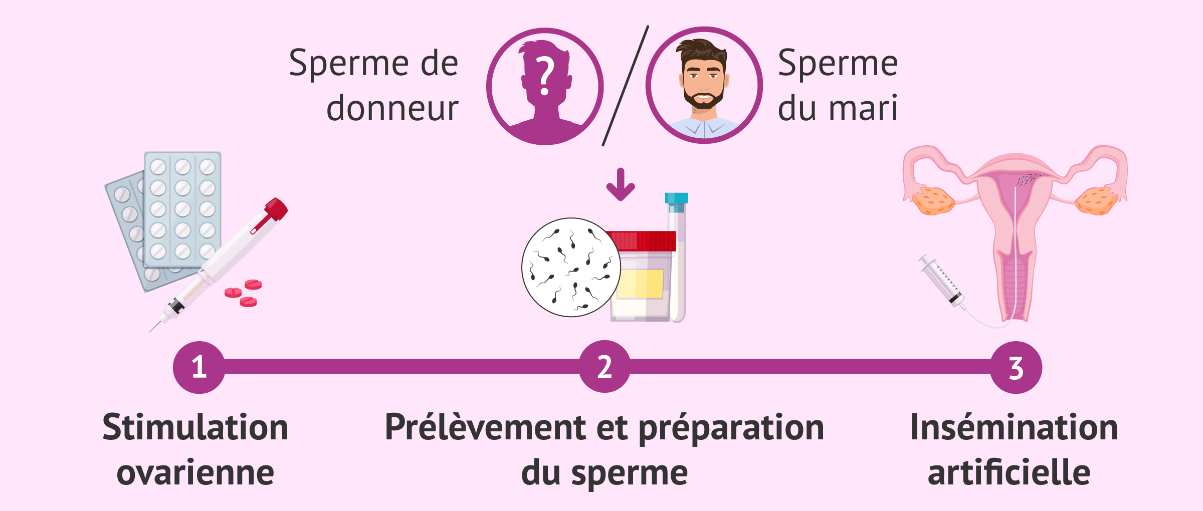 Imagen: Processus de l'IA avec sperme du conjoint ou d'un donneur