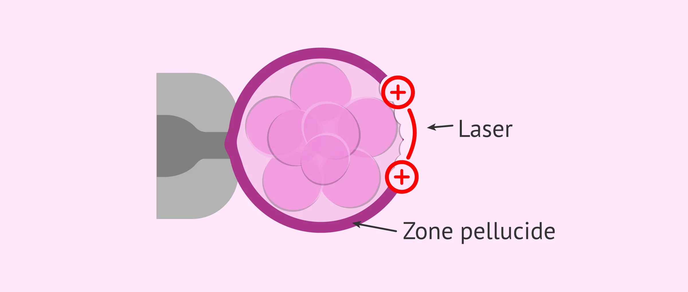 Imagen: L'éclosion assistée par laser