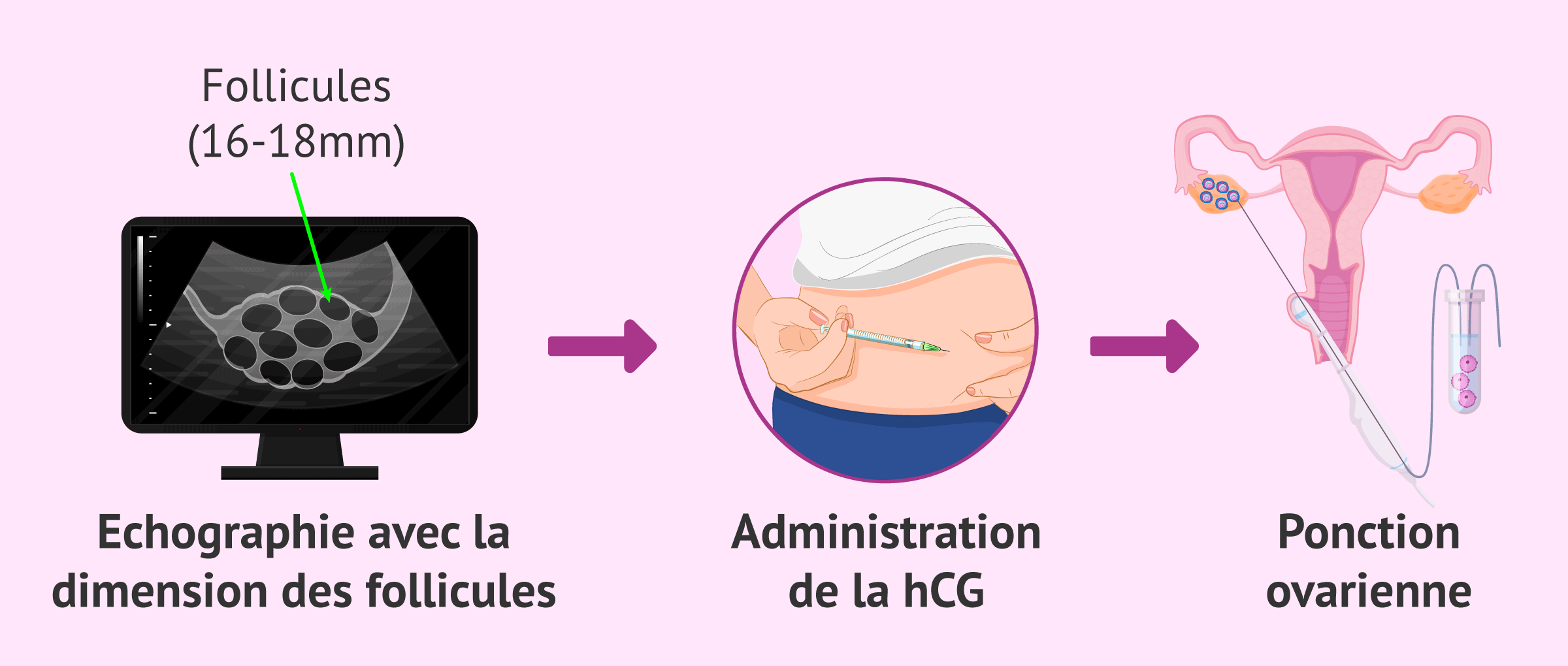 Imagen: Ponction ovarienne pour la méthode ROPA