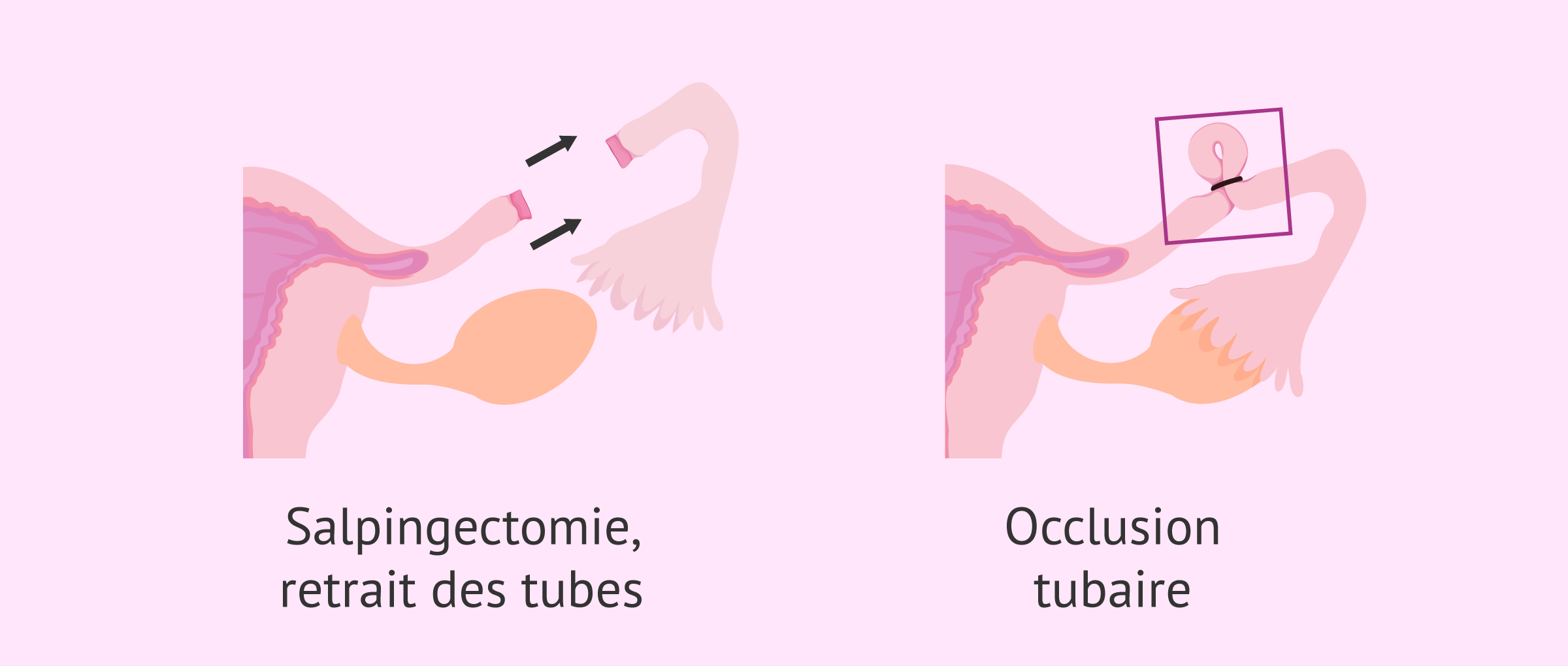 Imagen: Traitement chirurgical de l'hydrosalpinx