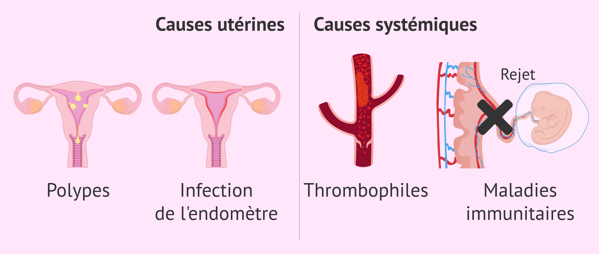 Imagen: Causes utérines et systémiques de l'échec de l'implantation