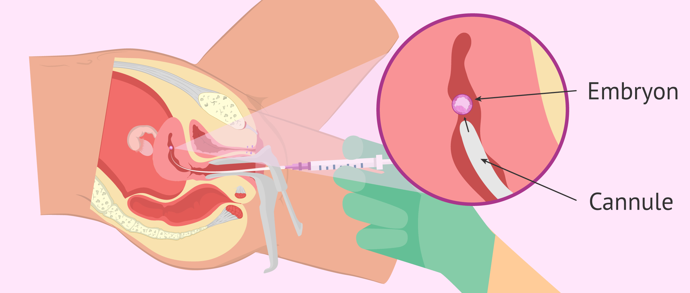 Imagen: Phase de transfert d'embryon