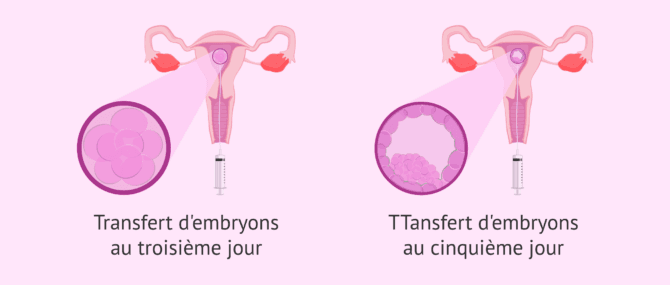Imagen: Quel jour le transfert d'embryons est-il effectué?