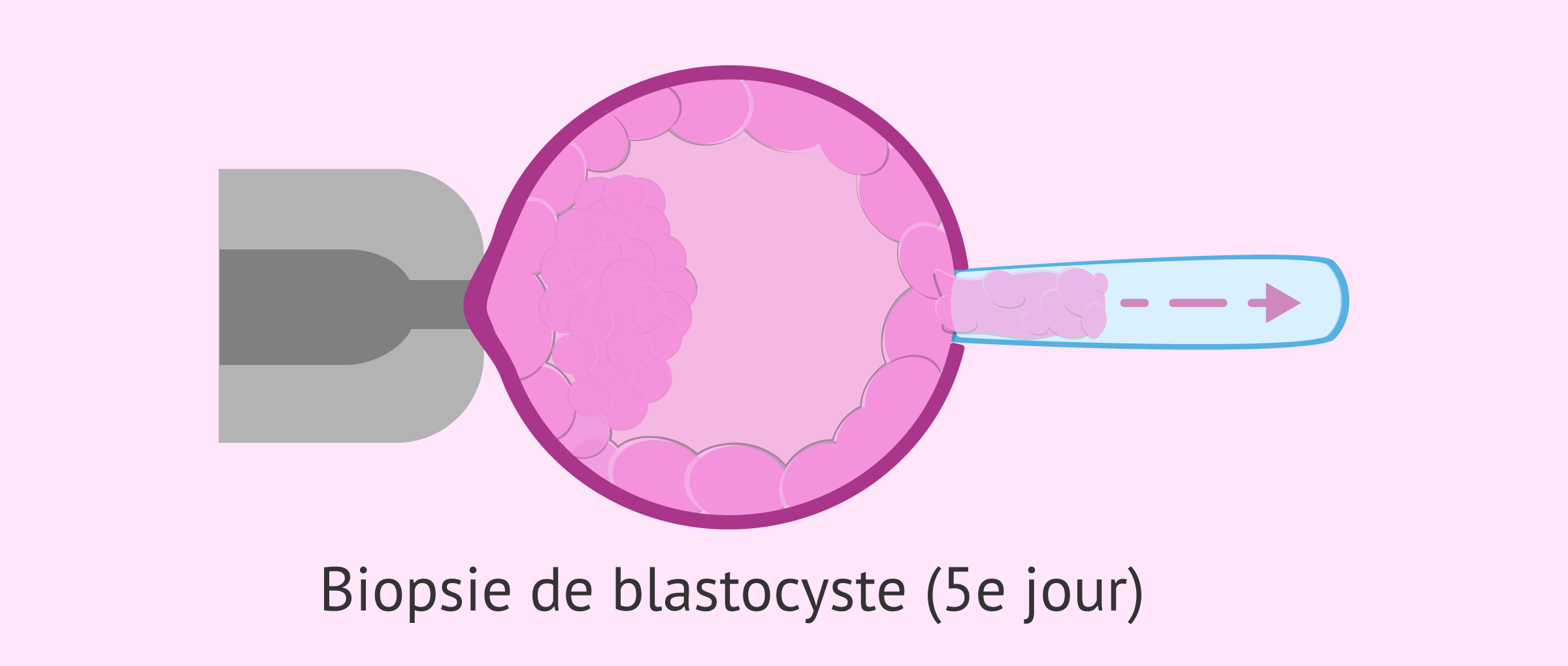Imagen: Biopsie du trophoectoderme le 5e jour
