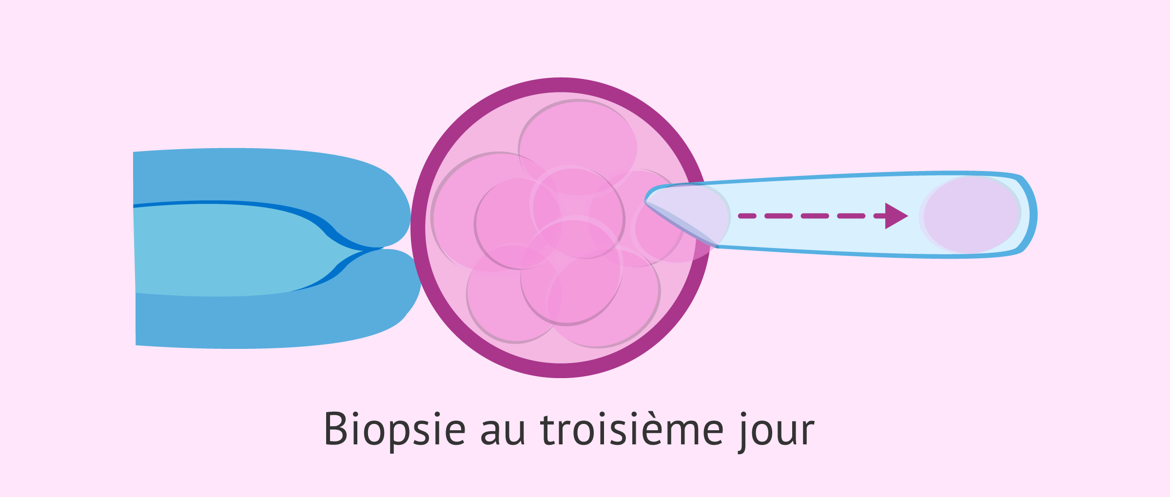 Imagen: Biopsie du blastomère au troisième jour