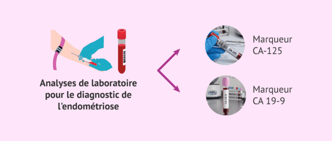 Imagen: Analyse des marqueurs tumoraux dans le diagnostic de l'endométriose