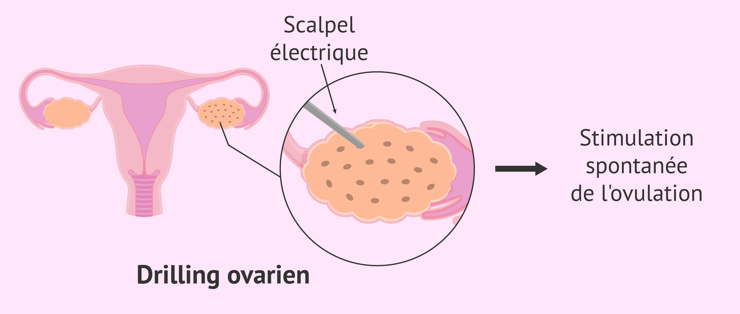 Imagen: Drilling ovarien pour perforer l'ovaire