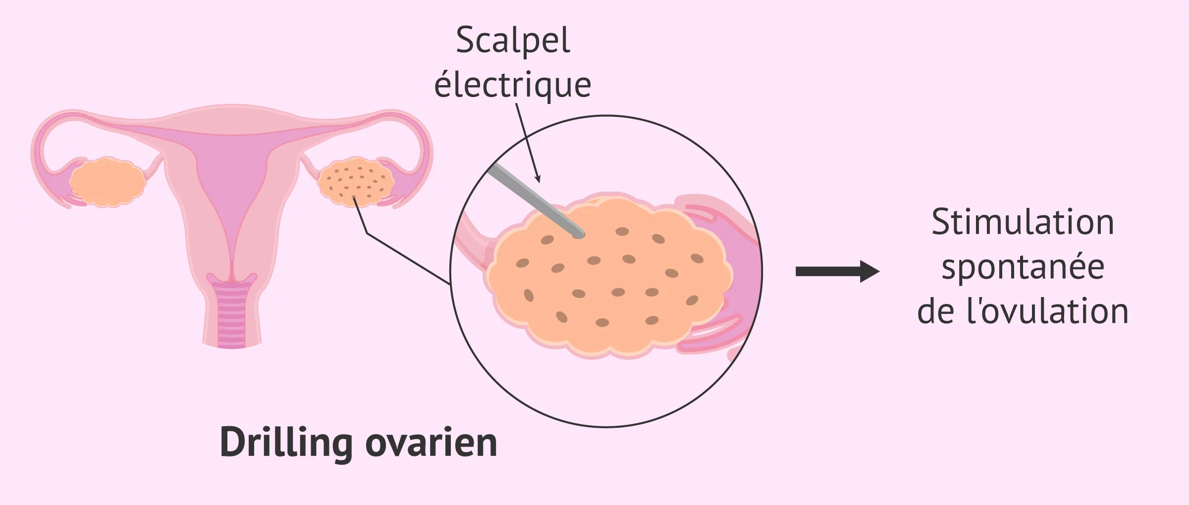 Imagen: Drilling ovarien pour perforer l'ovaire