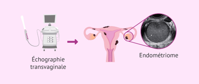 Imagen: Échographie transvaginale pour détecter les kystes chocolat