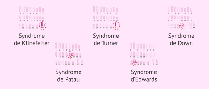 Imagen: Anomalies chromosomiques numériques