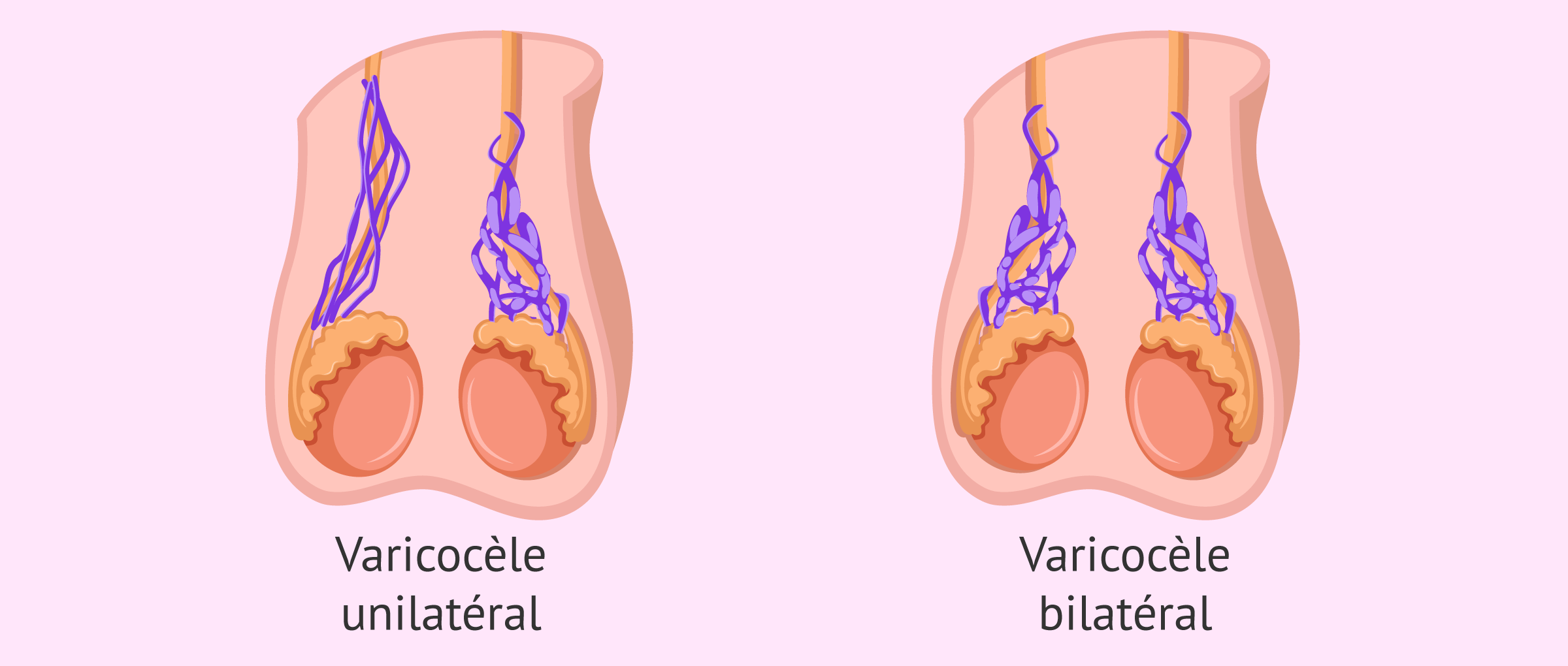 Imagen: Varicocèle bilatéral ou unilatéral
