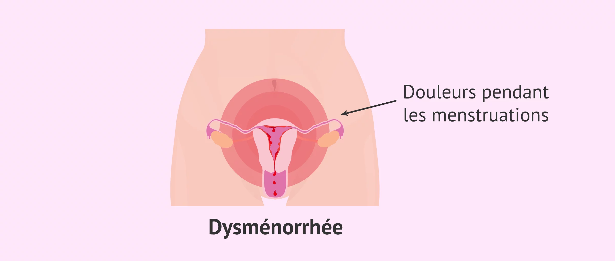 Dysménorrhée solution naturelle