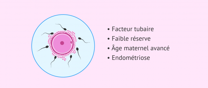 Imagen: Fécondation in vitro (FIV) et infertilité féminine