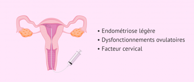 Imagen: Insémination artificielle (IA) et infertilité féminine