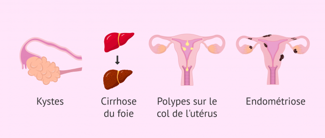 Imagen: Facteurs de risque de l'hyperplasie endométriale