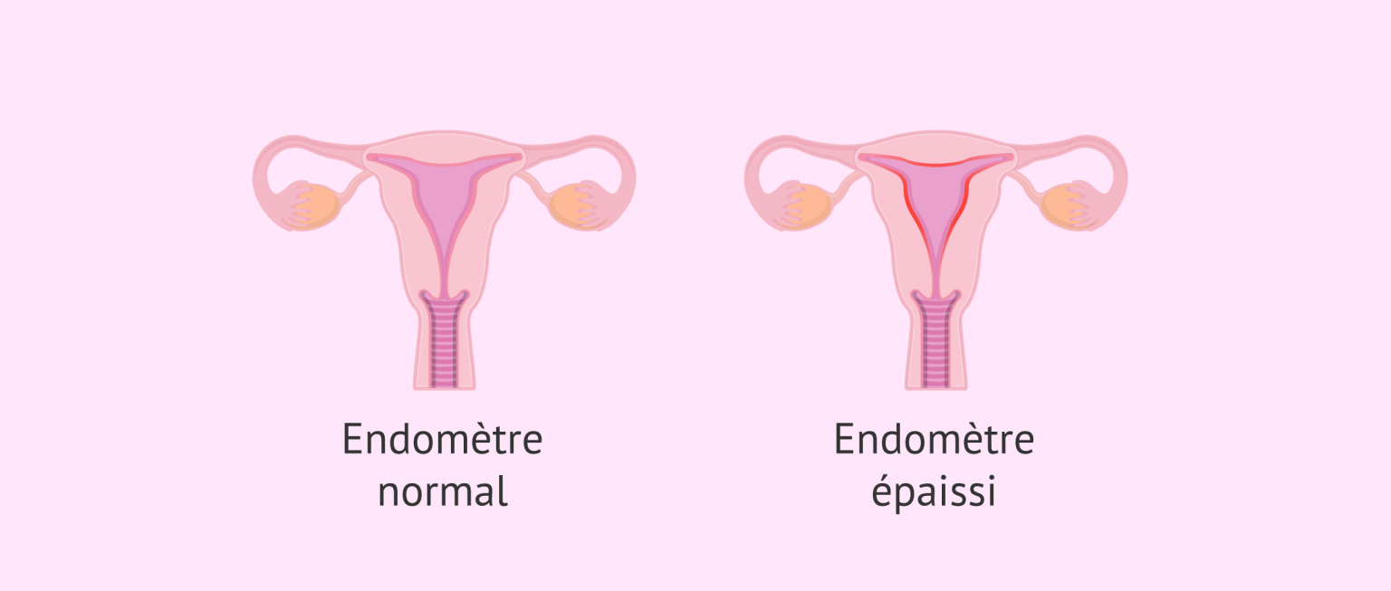 qu-est-ce-que-l-hyperplasie-de-l-endom-tre-et-pourquoi-se-produit-elle