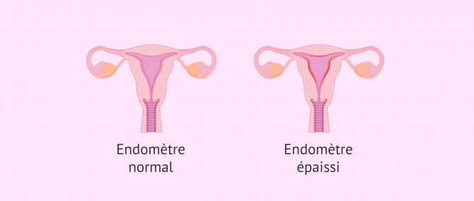 Imagen: Endomètre normal et endomètre avec hyperplasie