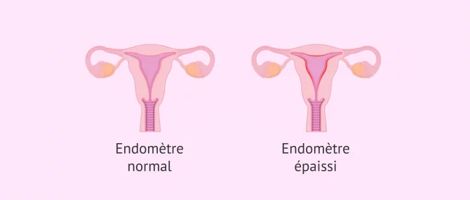 Imagen: Endomètre normal et endomètre avec hyperplasie