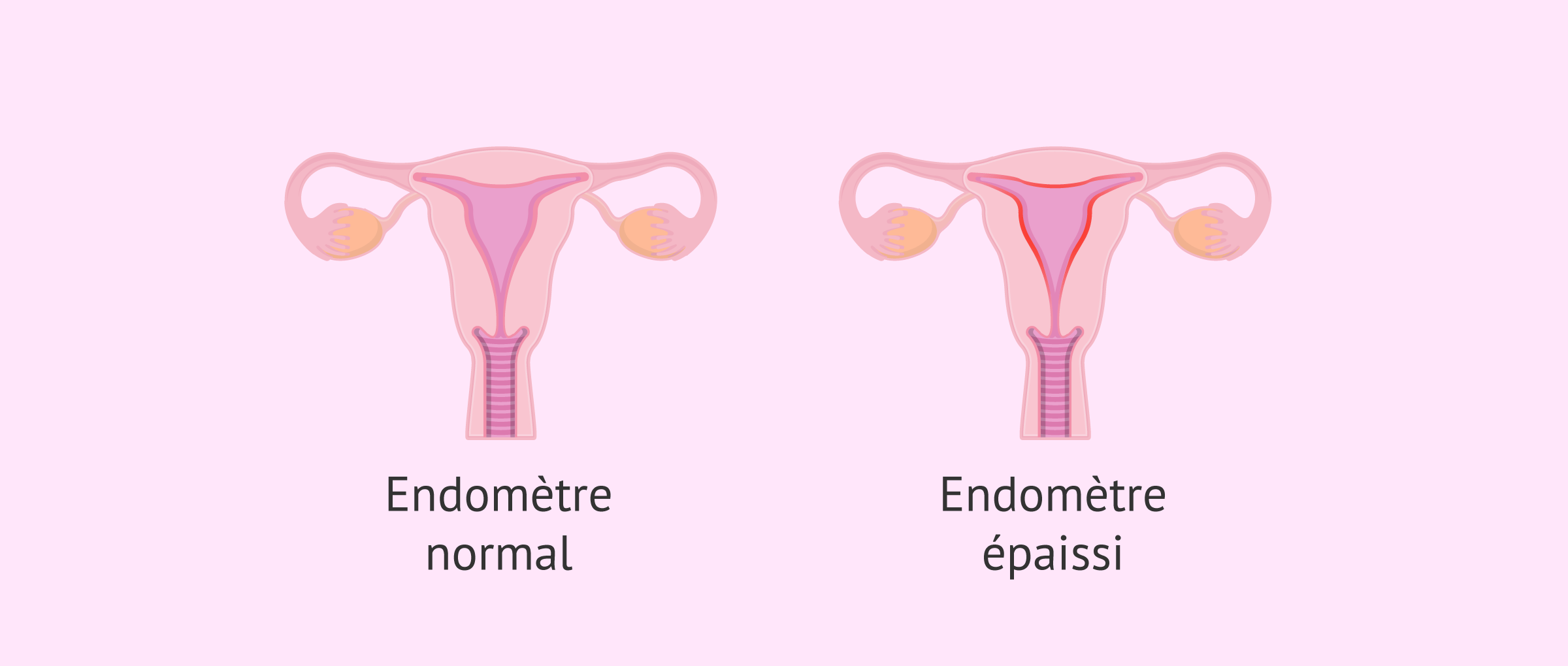 Qu'est-ce que l'hyperplasie de l'endomètre et pourquoi se produit ...