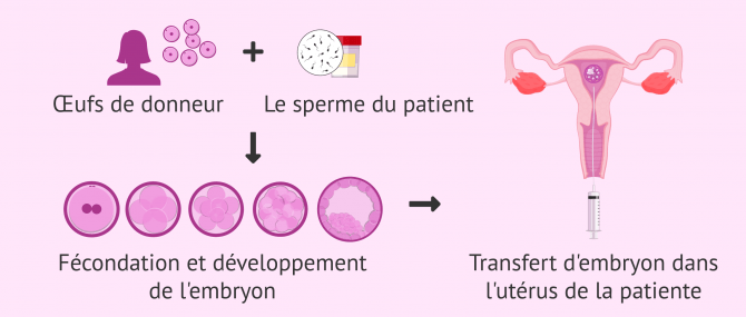 Imagen: Ovodonation et infertilité féminine