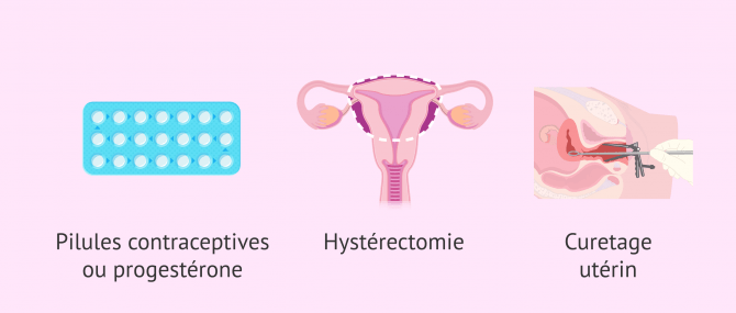 Imagen: Options de traitement de l'hyperplasie de l'endomètre