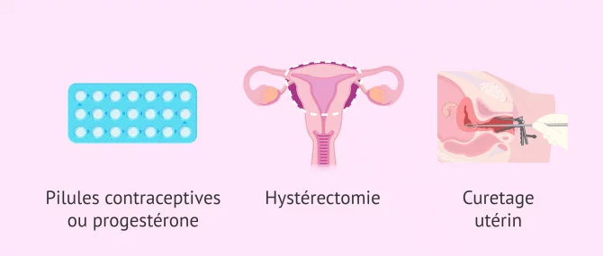 Imagen: Options de traitement de l'hyperplasie de l'endomètre