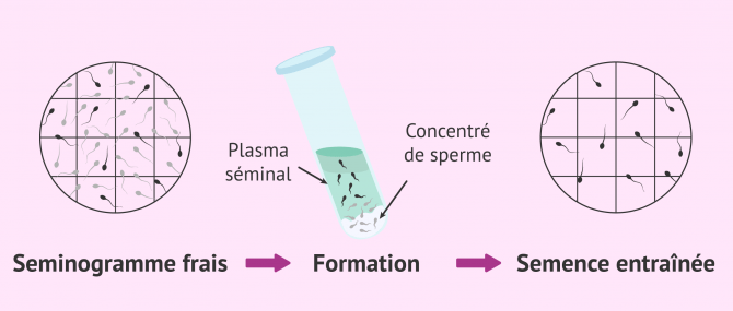 Imagen: Résultats du séménogramme REM