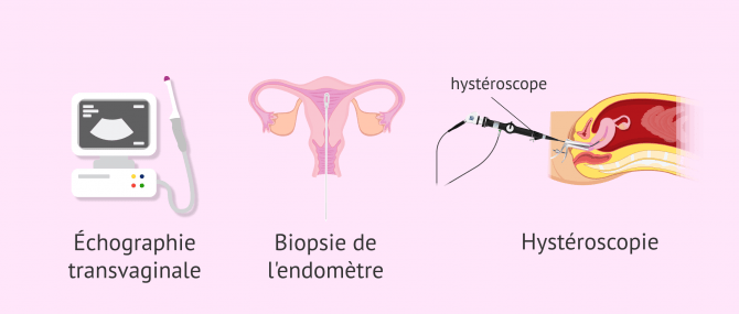 Imagen: Tests de diagnostic de l'hyperplasie de l'endomètre