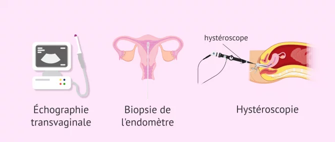 Imagen: Tests de diagnostic de l'hyperplasie de l'endomètre