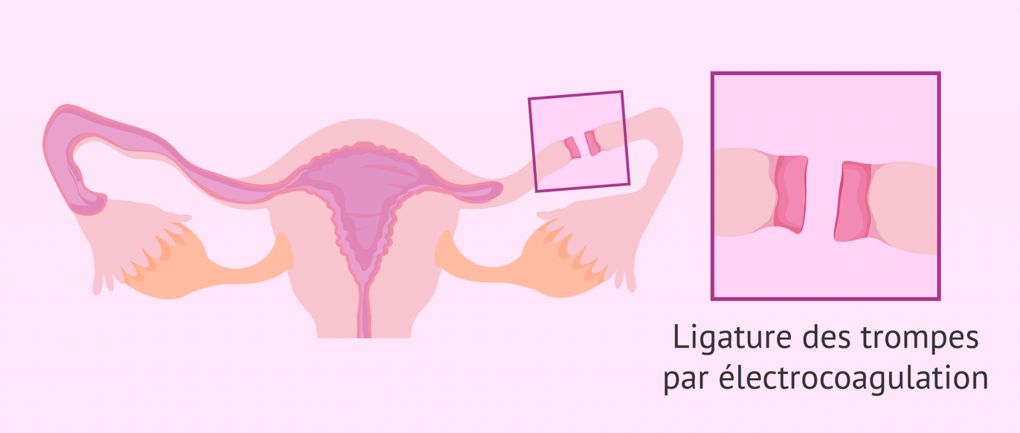 Qu'esce que la ligature des trompes? Avantages et conséquences
