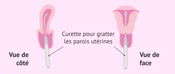 Imagen: Curetage ou curetage des parois utérines