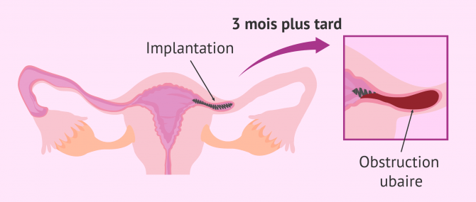 Imagen: Ligature des trompes Essure