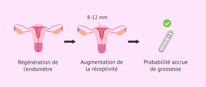 Imagen: Objectifs du scratching endométrial