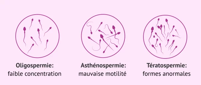 Imagen: Oligoasthénotératospermie