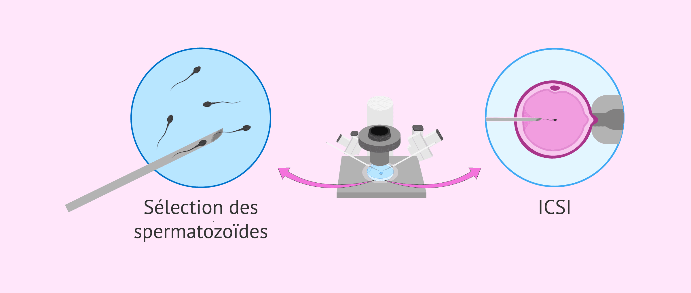 Imagen: Oligoasthénotératospermie et procréation assistée
