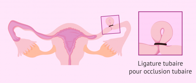 Imagen: Ligature des trompes avec des clips ou des agrafes