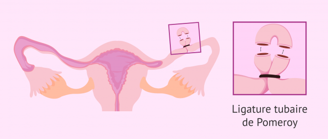 Imagen: Technique de Pomeroy pour la ligature des trompes