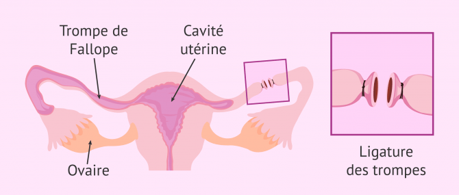 Imagen: Chirurgie de ligature des trompes