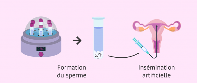 Imagen: Insémination artificielle avec capacitation du sperme